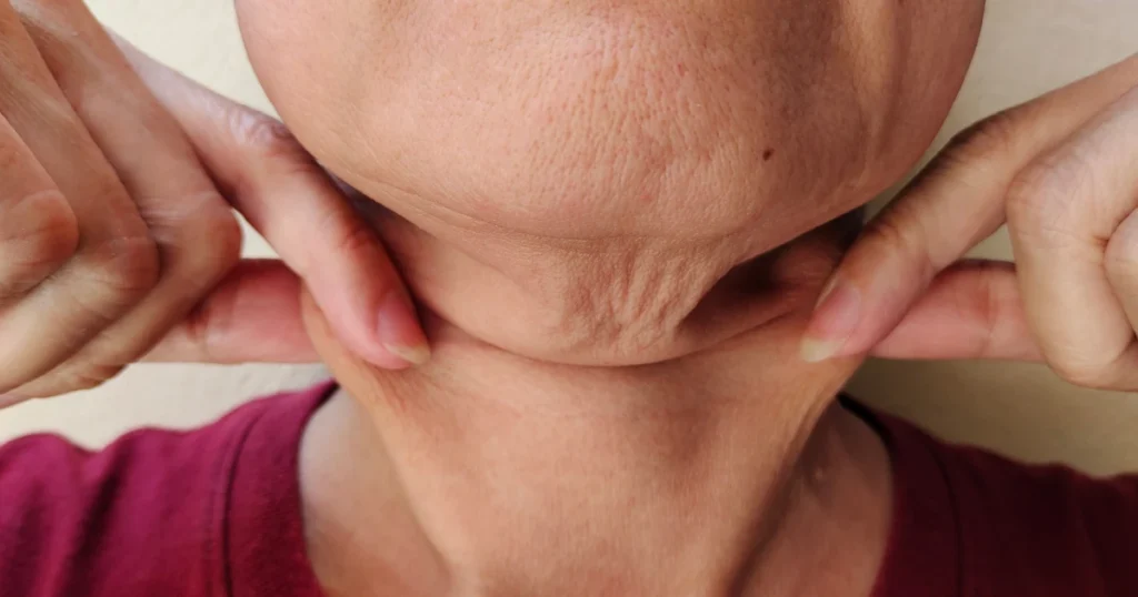 Flacidez Facial y de Cuello
