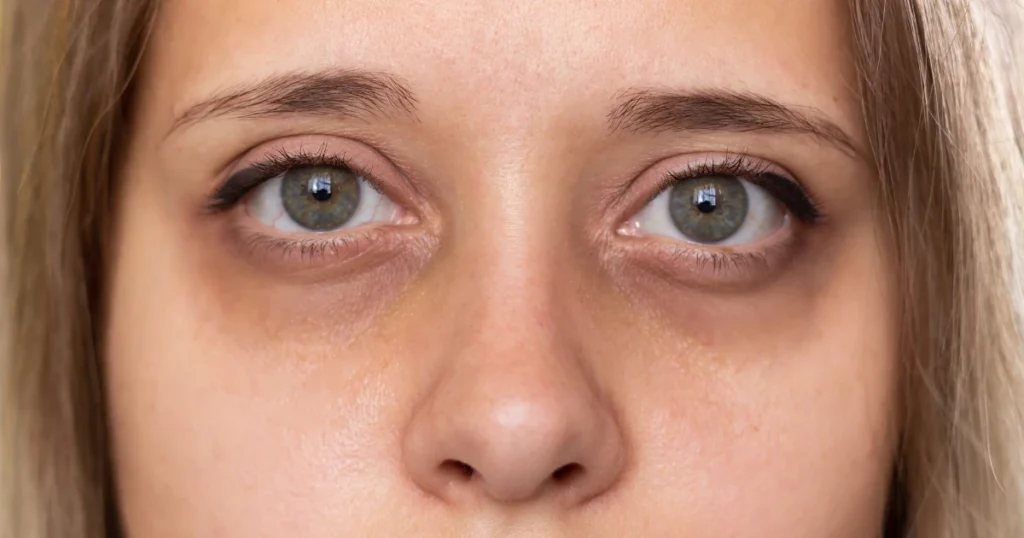 ¿Por Qué Aparecen las Ojeras Hundidas?