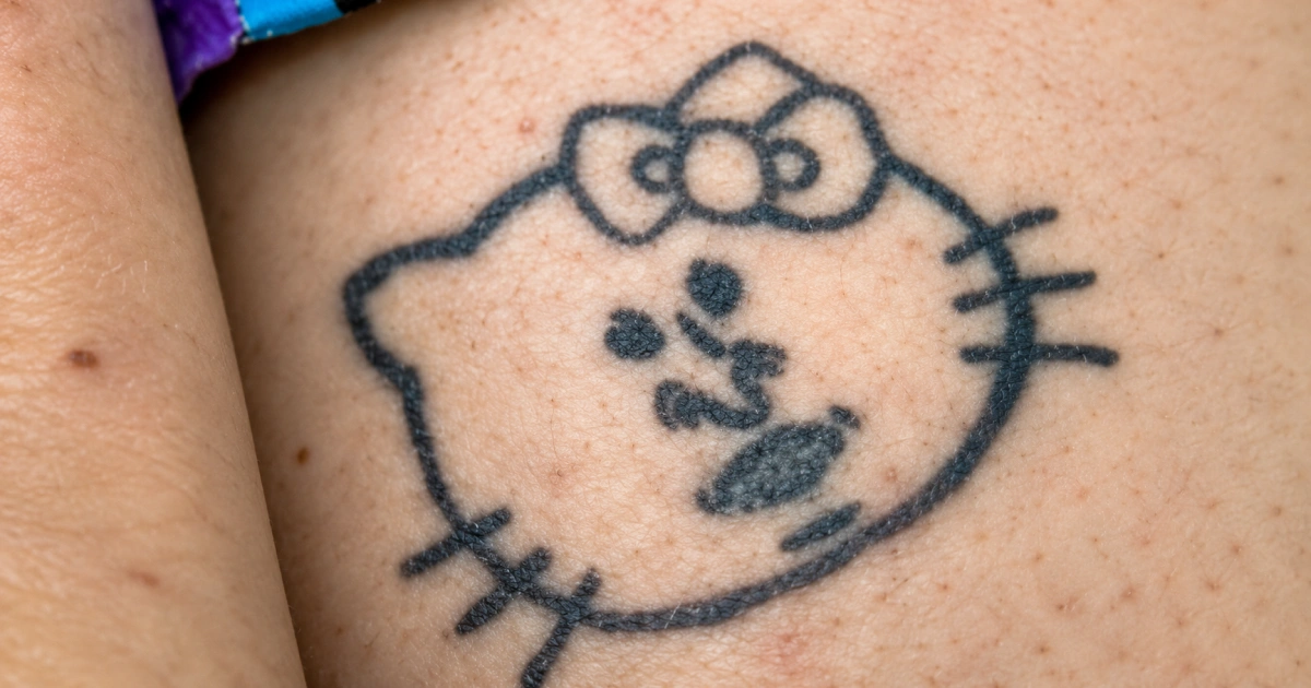 Cómo eliminar un tatuaje Jinotepe